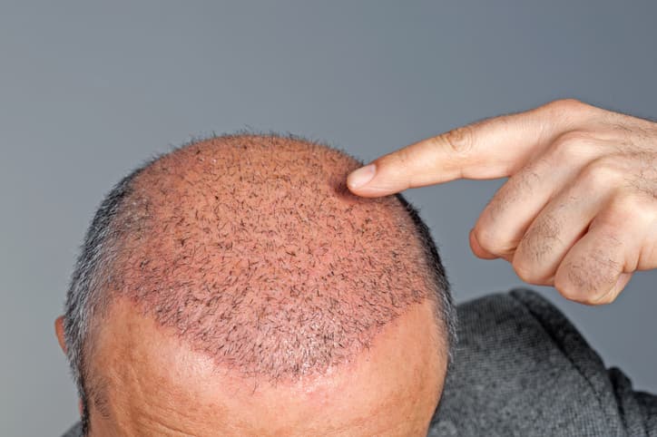 Haartransplantation (Vorbereitung und Nachsorge)
