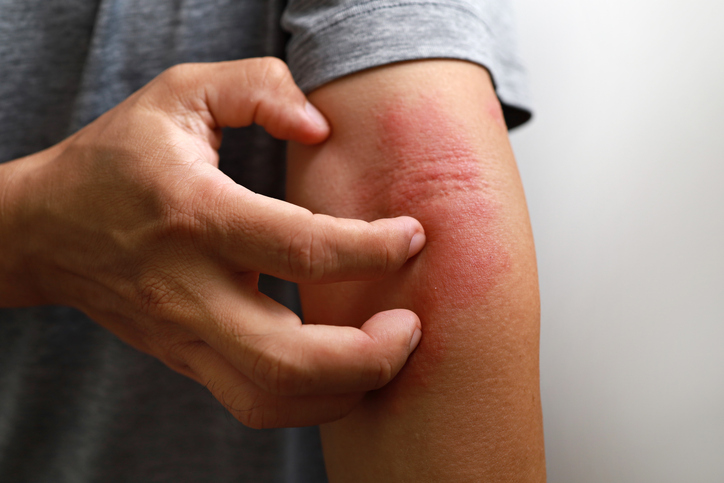 Atopische Dermatitis
